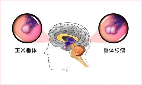 垂體瘤經鼻蝶術后鼻腔愈合時間及清潔護理指南